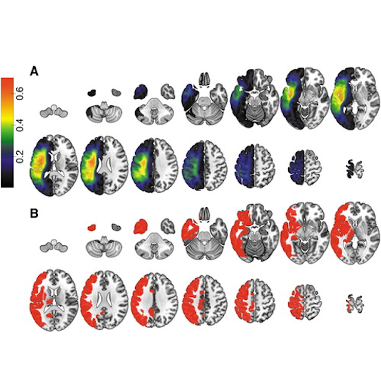 Effect of stroke on contralateral functional connectivity